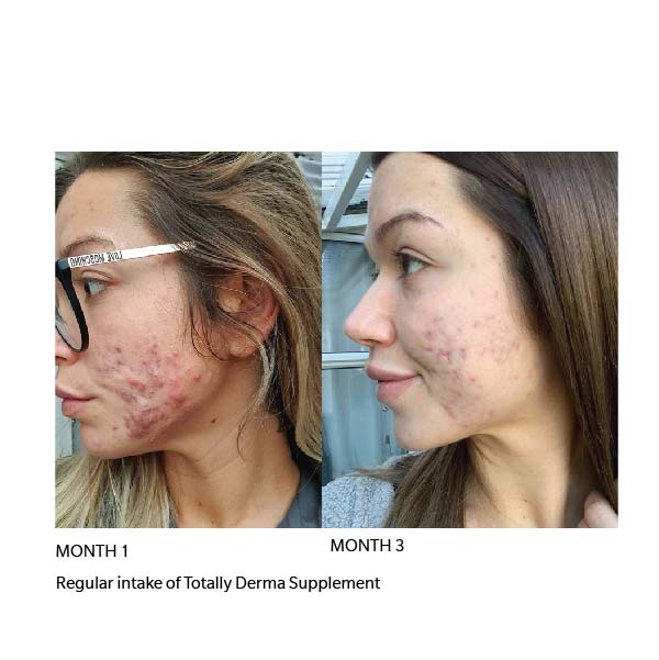Before After TOTALLY DERMA dermoi!