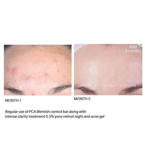 before after pca skin acne gel clarify night retinol dermoi!
