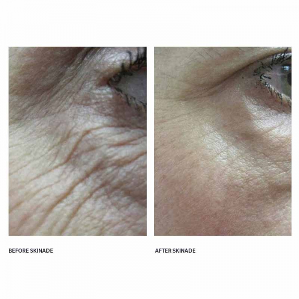 dermoi skinade before after eye